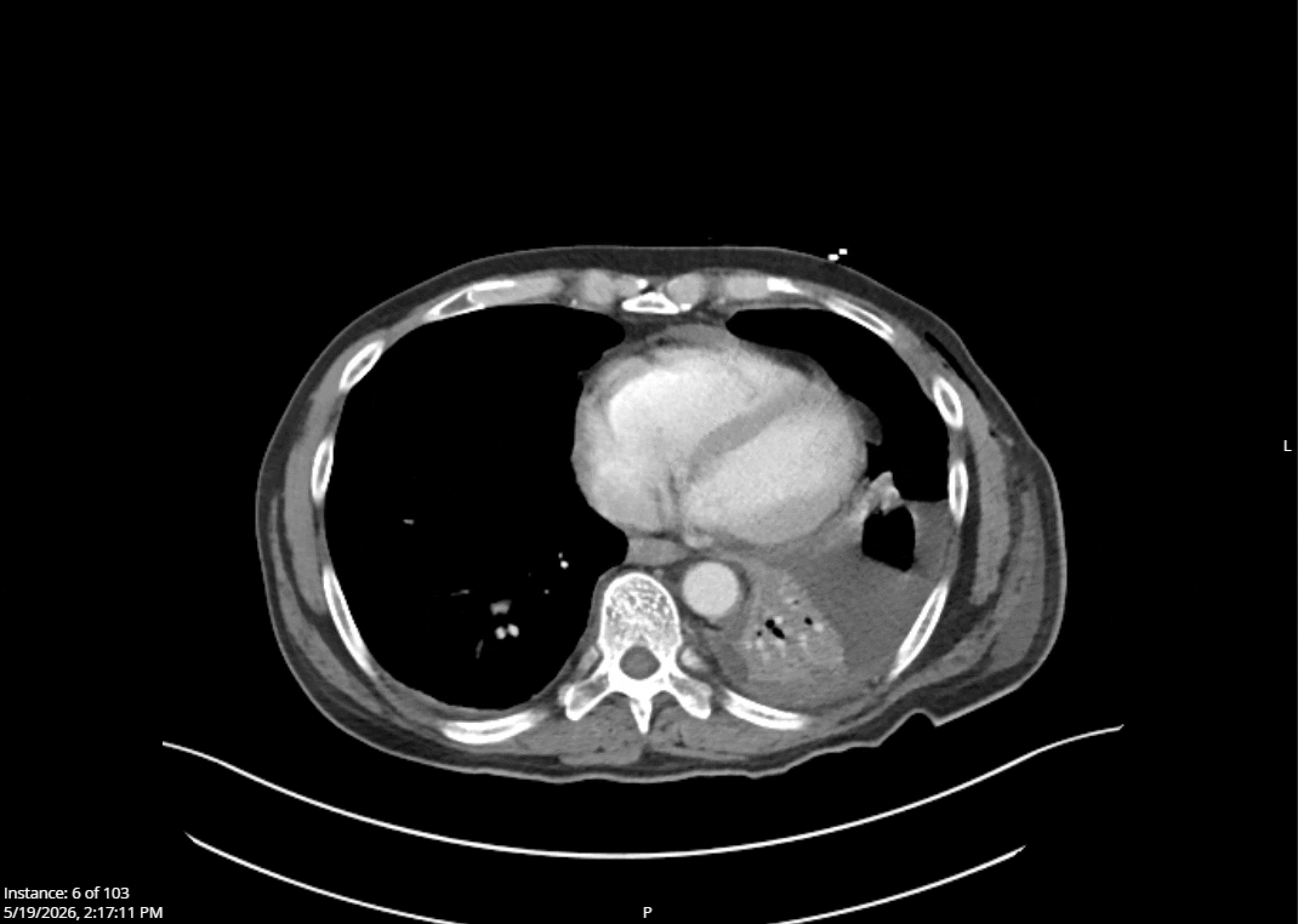 CT abdomen/pelvis cine loop, 5/19