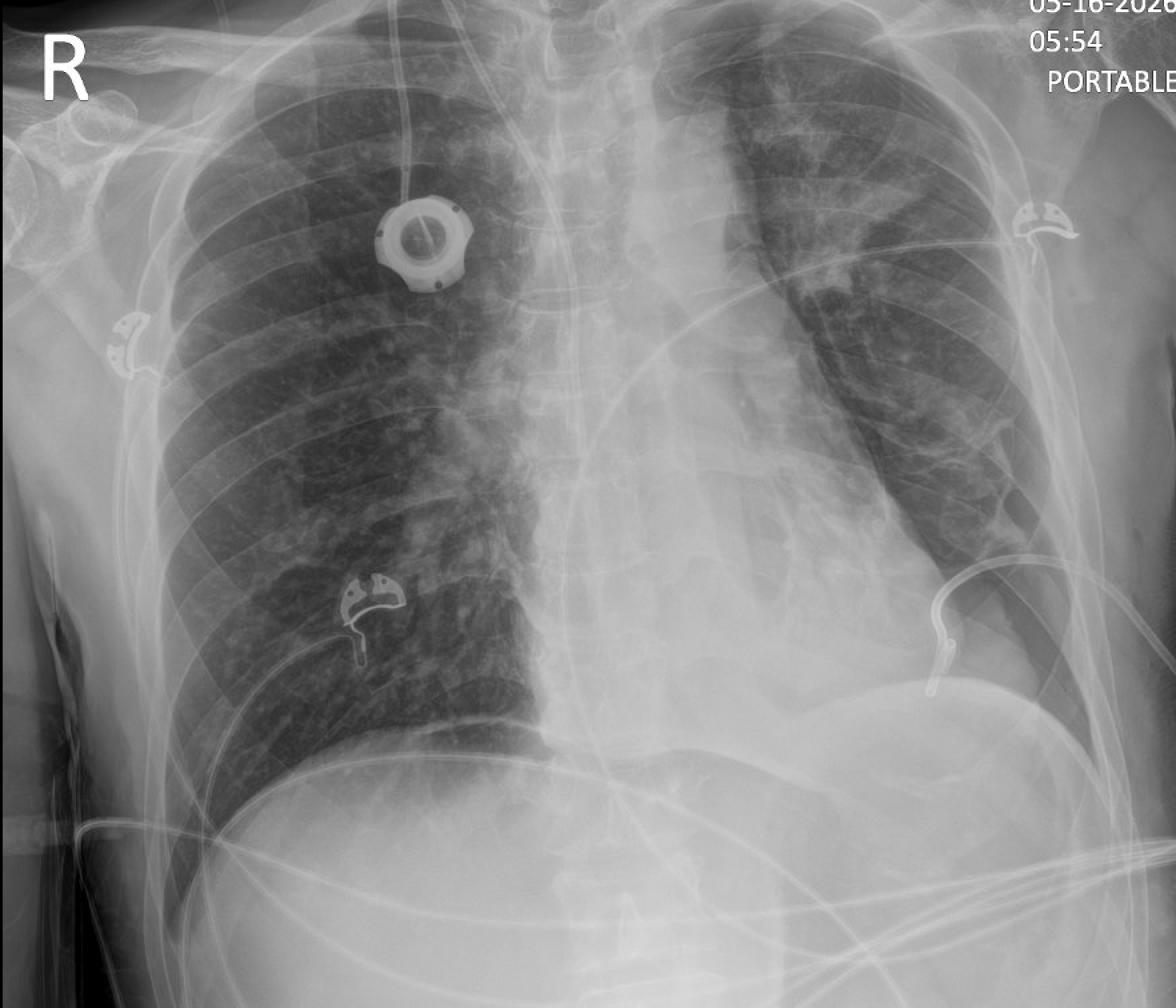 Chest radiograph 5/16