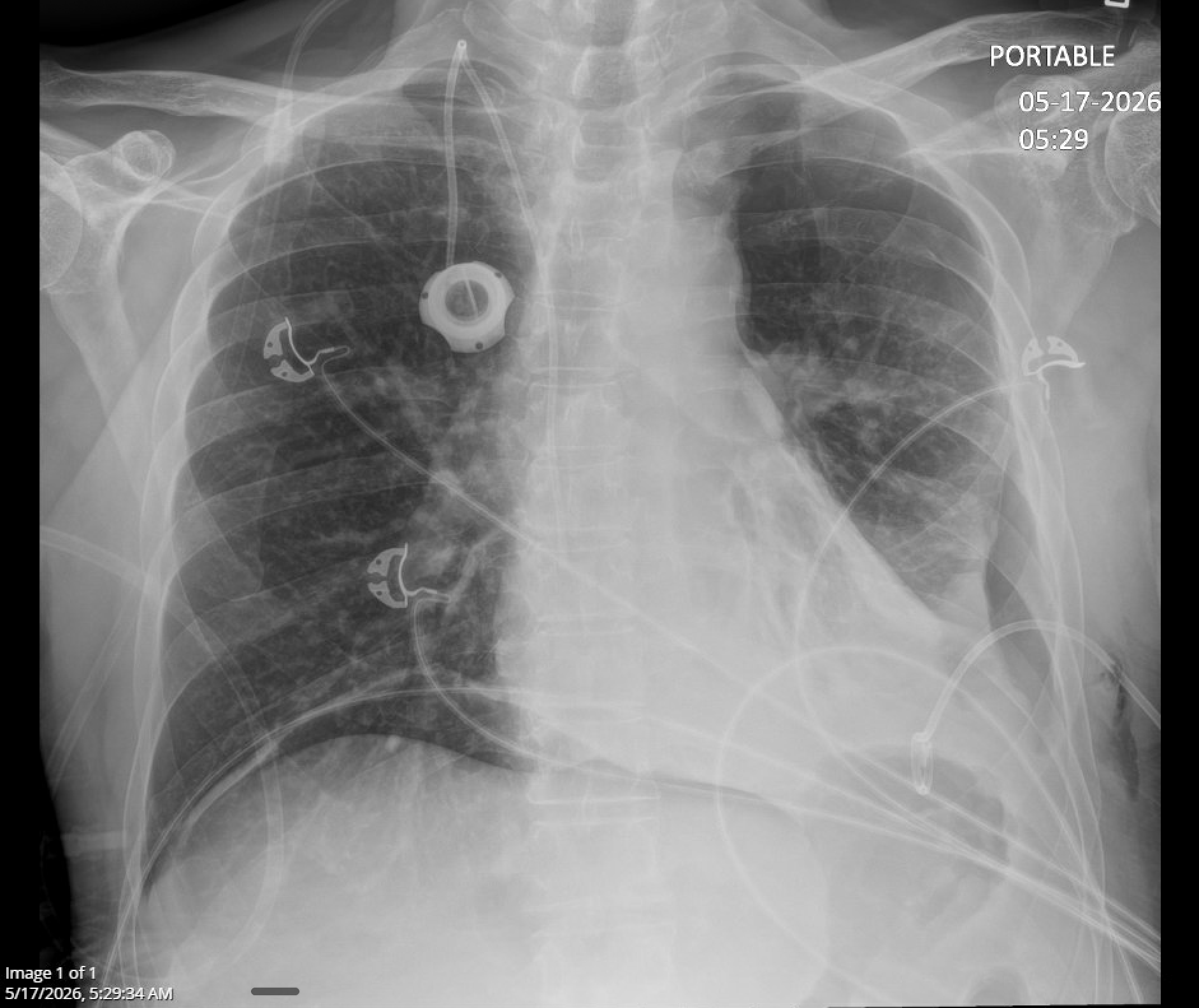 Chest radiograph 5/17
