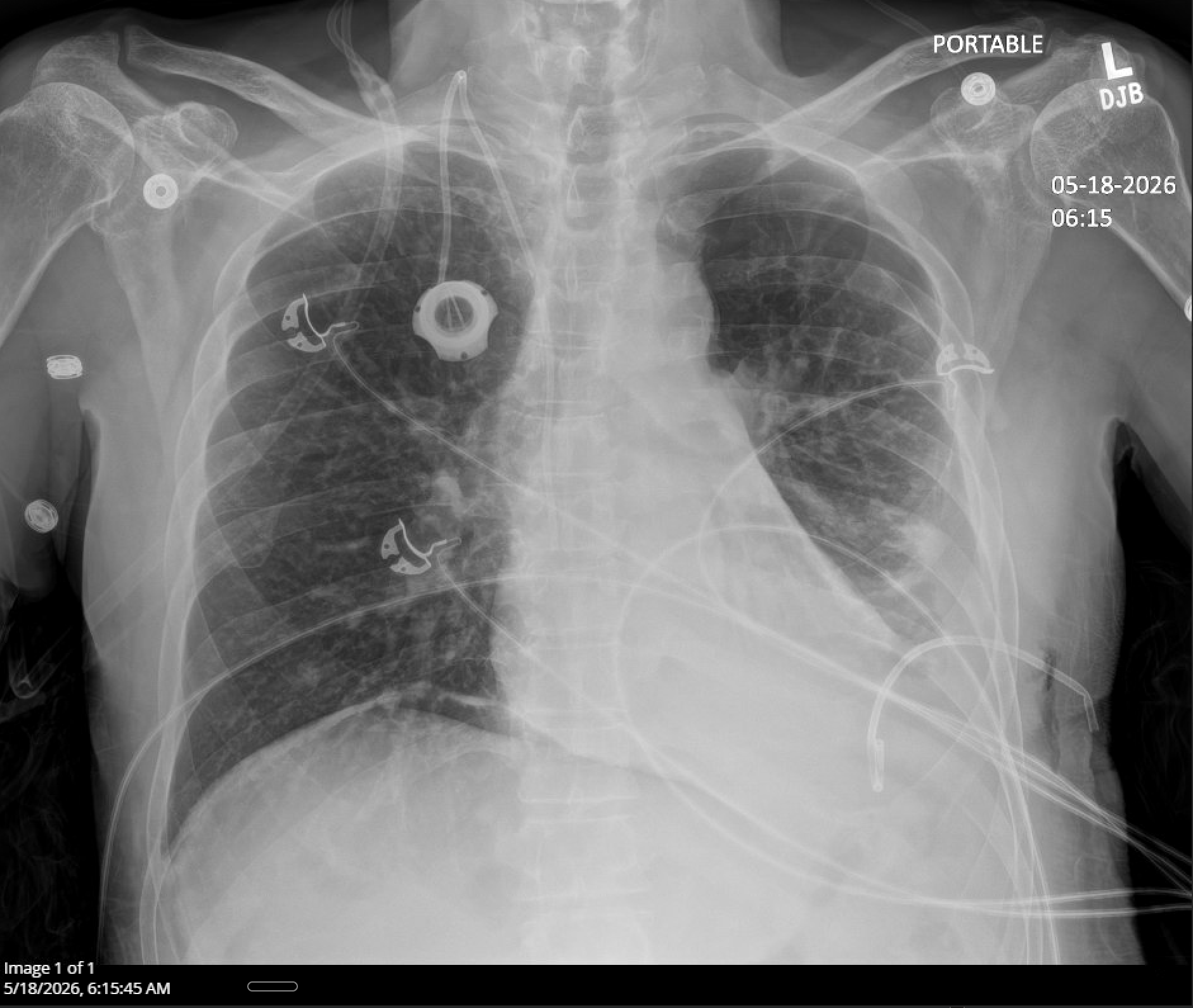 Chest radiograph 5/18